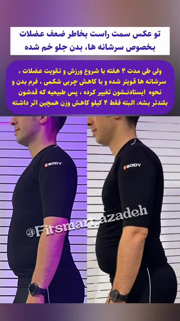 لاغری با دستگاه موضعی و ایکس بادی، قبل و بعد لاغری، چربیسوزی