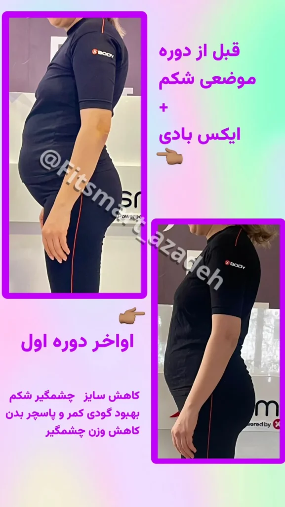 لاغری با دستگاه موضعی و ایکس بادی، قبل و بعد لاغری، چربیسوزی