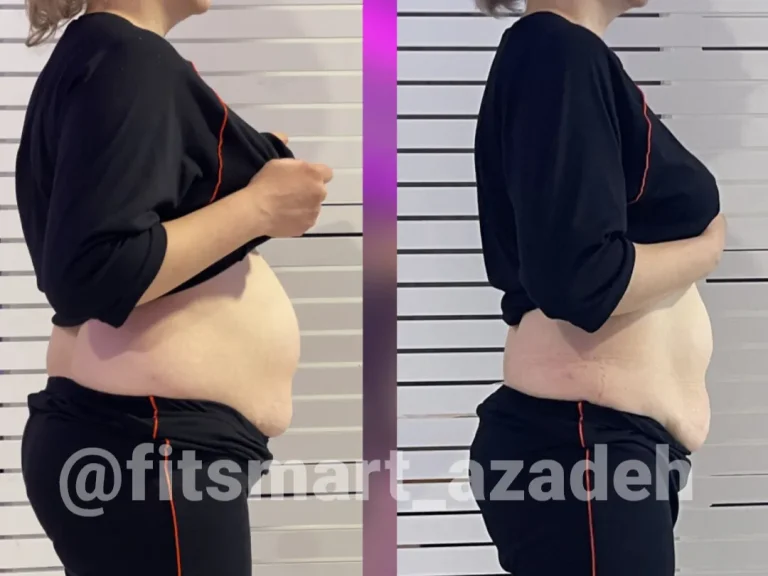 لاعری شکم پهلو، لاغری با دستگاه، لاغری موضعی، قبل و بعد، فیت اسمارت، کاهش سایز شکم، کاهش وزن