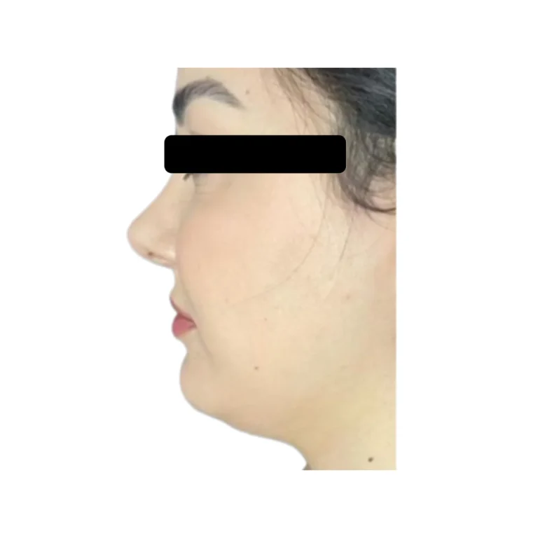 لاغری چربی غبغب