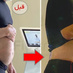 چربیسوزی شکم پهلو، کاهش سایز شکم، قبل و بعد