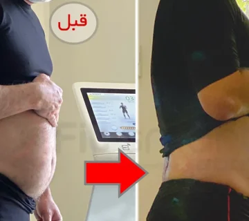 چربیسوزی شکم پهلو، کاهش سایز شکم، قبل و بعد