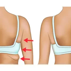 لاغری پشت و خط سوتین، چربیسوزی پشت، لاغری موضعی خط سوتین