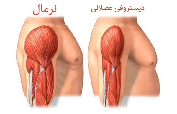 عضلات ضعیف، آتروفی عضله، عضله سازی